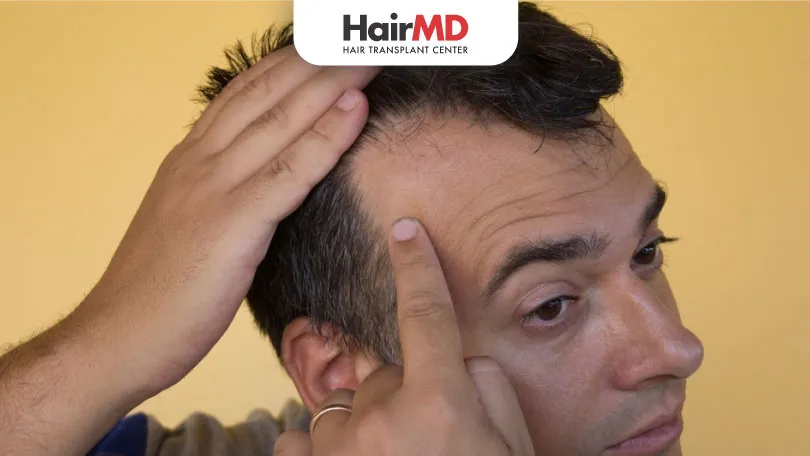 Does-Minoxidil-Work-on-the-Hairline-or-Frontal-Baldness-HairMD-Pune