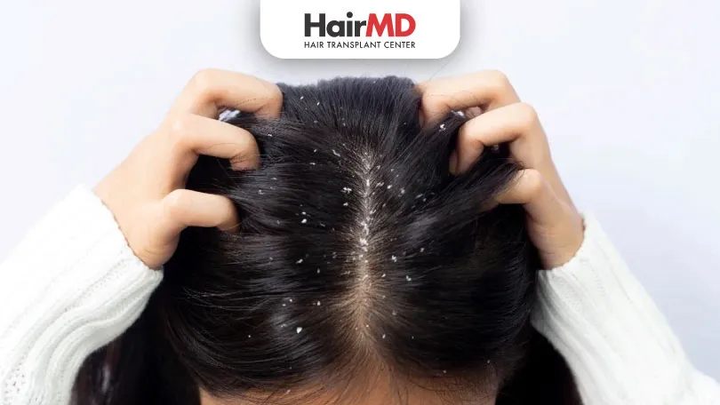 Effective-Ways-to-Prevent-Dandruff-HairMD-Pune