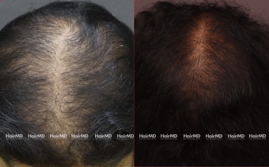 Female Hair Loss Results 7 Sessions 6 Months HairMD Pune 1