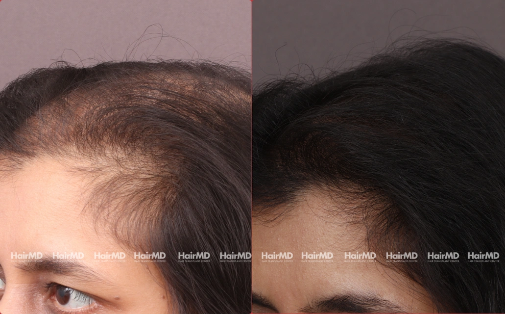 Female Hair Loss Results 7 Sessions 6 Months HairMD Pune 2