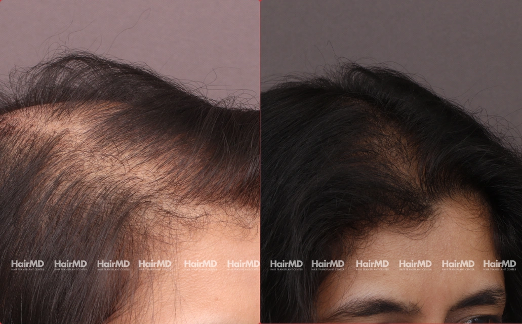 Female Hair Loss Results 7 Sessions 6 Months HairMD Pune 3