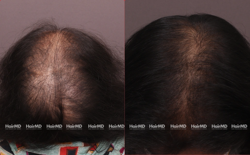 Female Hair Loss Results 7 Sessions 6 Months HairMD Pune 4