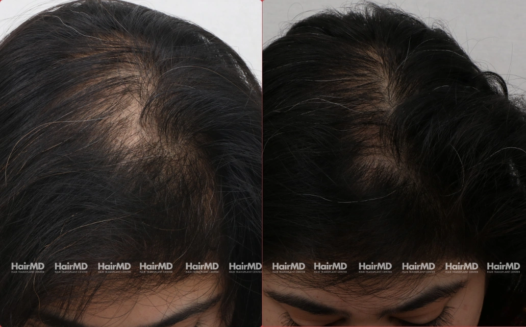 Female Hair Loss Results 7 Sessions 6 Months HairMD Pune 5