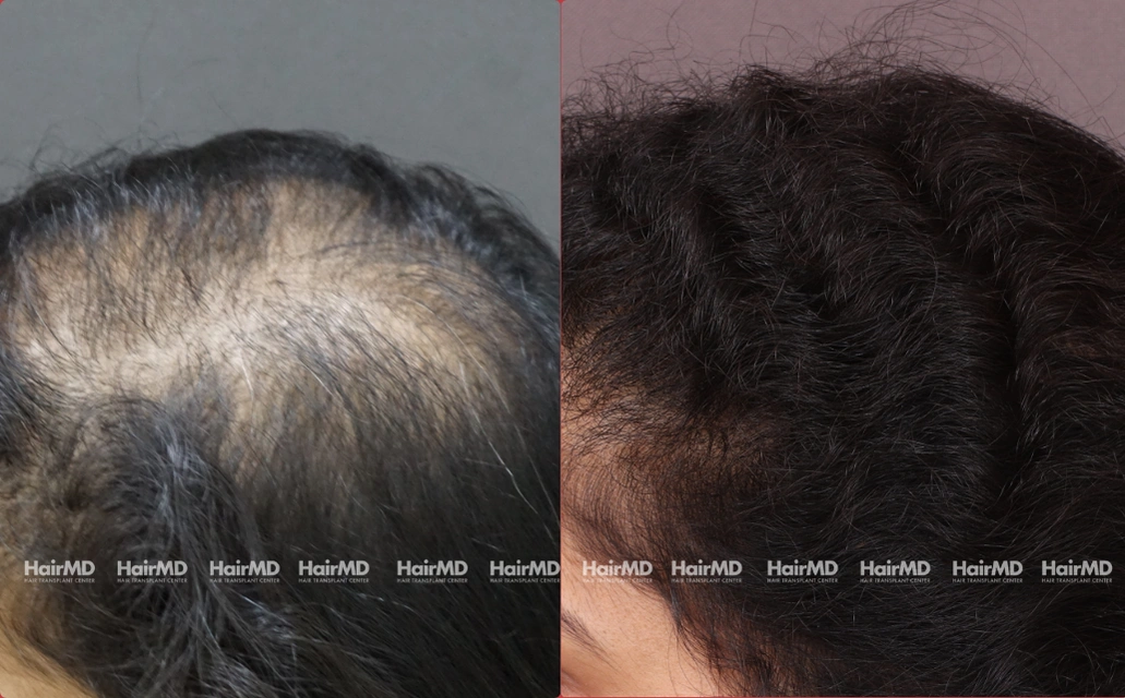 Female Hair Loss Results 7 Sessions 6 Months HairMD Pune