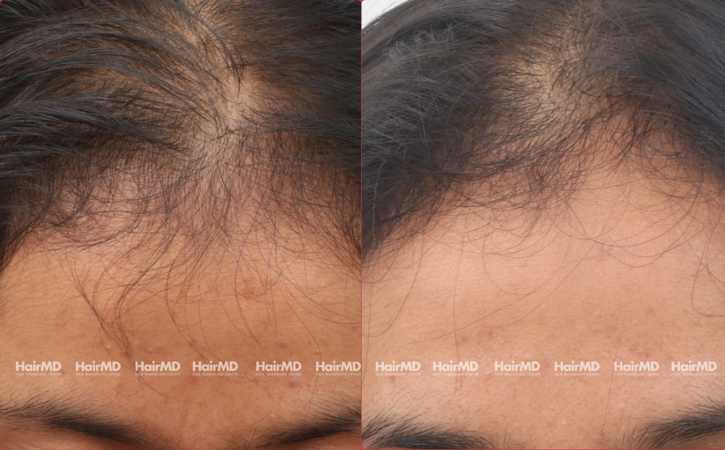 Female Hairloss Results 7 Sessions 6 Months HairMD Pune