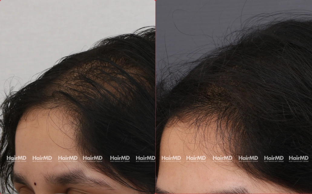 Female Hairloss Results 7 Sessions 6 Months HairMD Pune