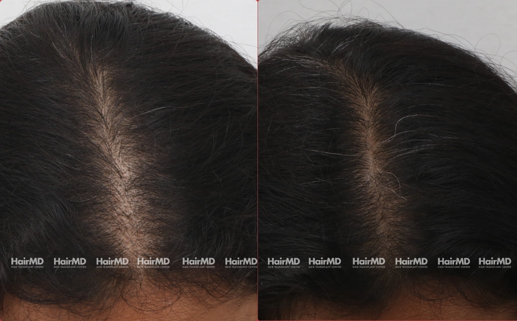 Female Hairloss Results 7 Sessions 6 Months HairMD Pune