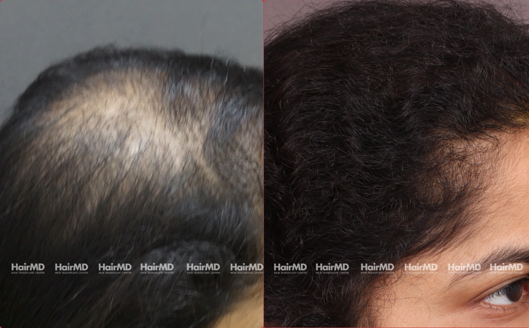 Female Hairloss Results 7 Sessions 6 Months HairMD Pune