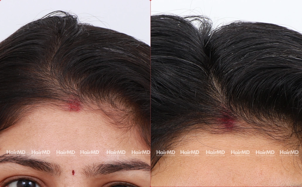 Female Hairloss Results 7 Sessions 6 Months HairMD Pune