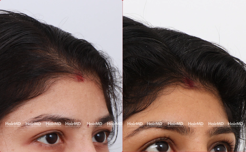 Female Hairloss Results 7 Sessions 6 Months HairMD Pune