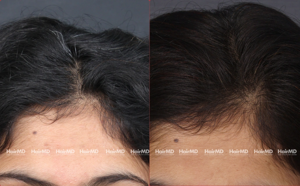 Female Hairloss Results 7 Sessions 6 Months HairMD Pune