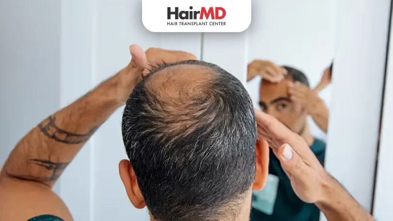 Finasteride For Male Pattern Hair Loss