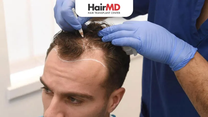 Guidelines-for-Choosing-the-Best-Hair-Transplant-Clinic-HairMD-Pune