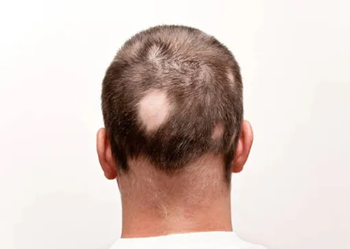 Hair Loss in Other Areas