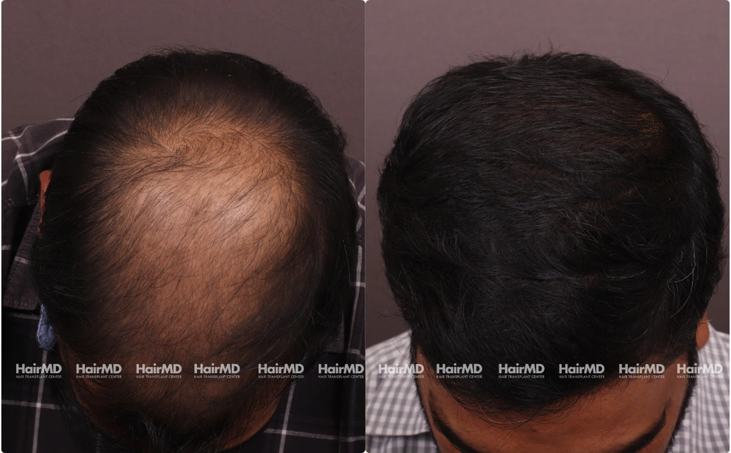 Hair Transplant Results 2 Years 4000 5000 Grafts HairMD Pune 1