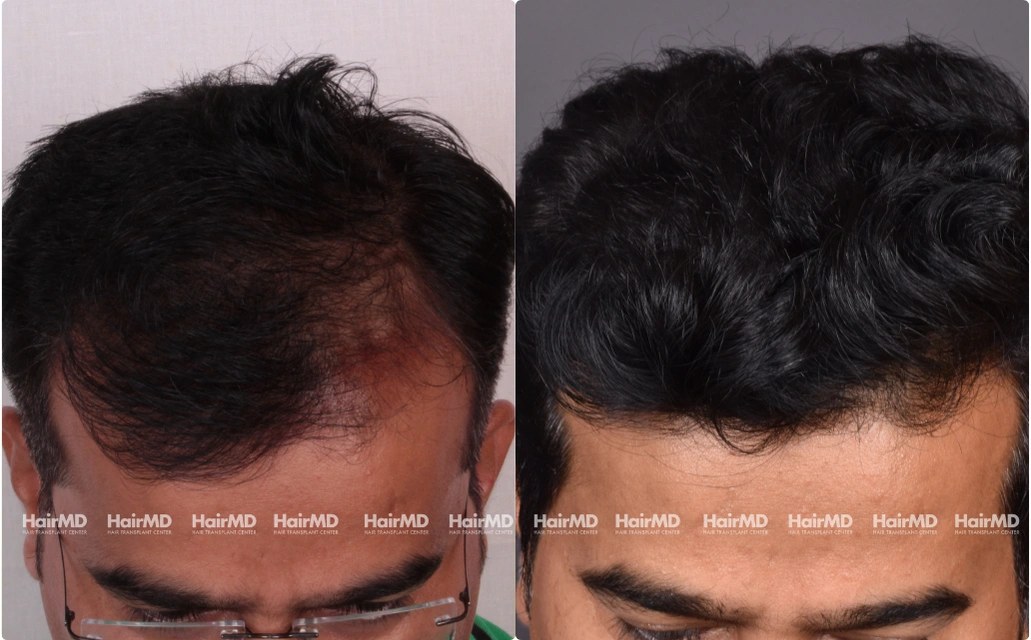 Hair Transplant Results 2 Years 4000 5000 Grafts HairMD Pune 2