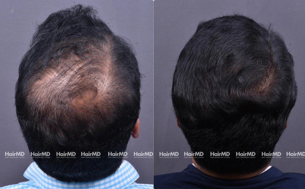 Hair Transplant Results 2 Years 4000 5000 Grafts HairMD Pune 3