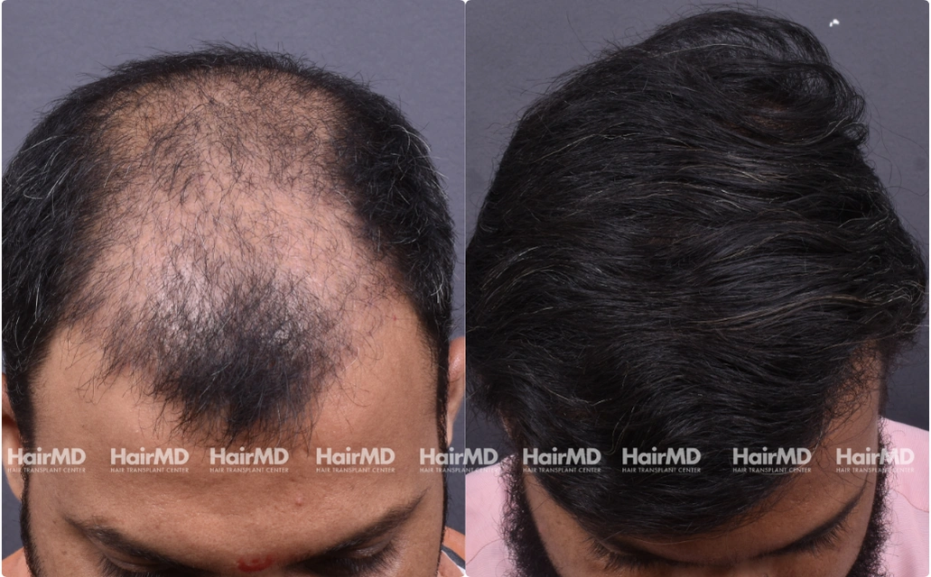 Hair Transplant Results 2 Years 4000 5000 Grafts HairMD Pune 5