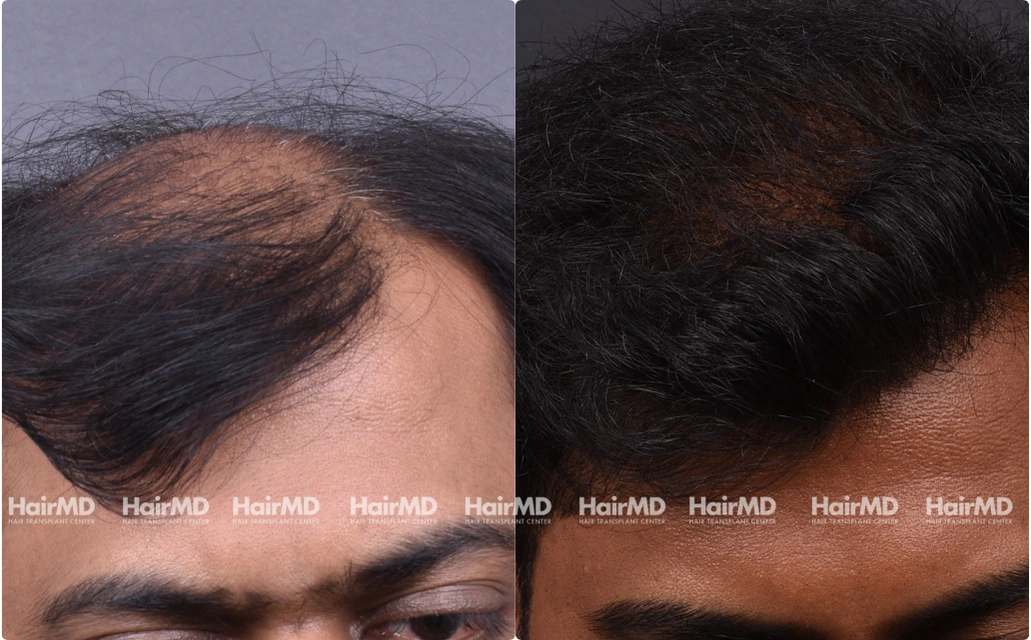 Hair Transplant Results 2 Years 4000 5000 Grafts HairMD Pune