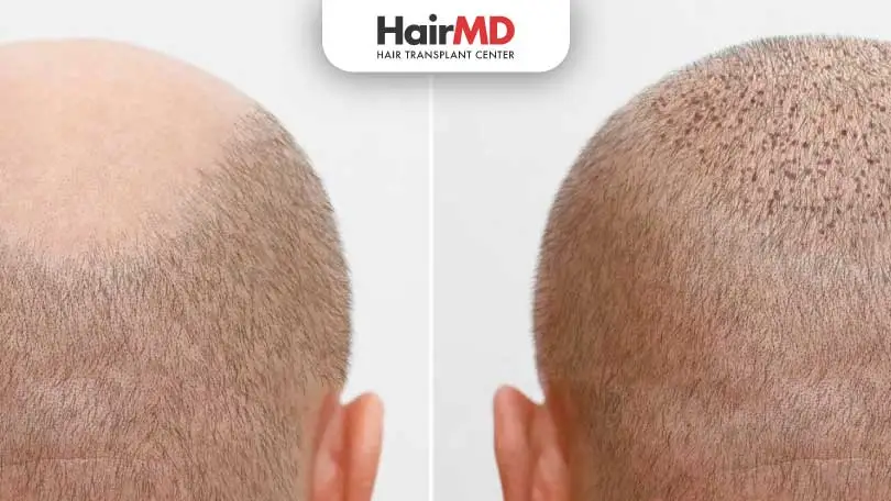 Understanding Hair Transplant Results: Simple Guide for Patients