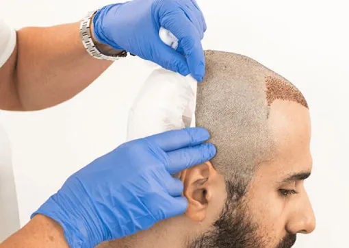 Hair Transplant Surgery