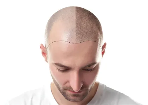 Hair Transplant