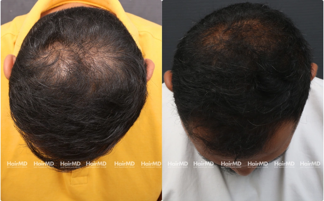 Hairtransplant Results 2 Years 2000-3000 Grafts HairMD Pune