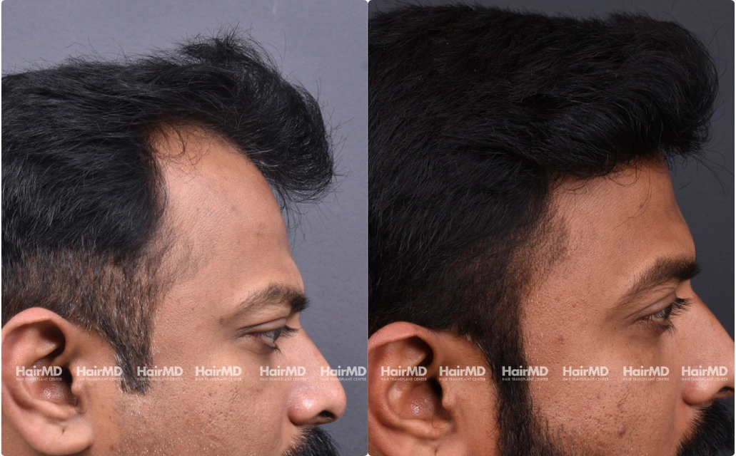 Hairtransplant Results 2 Years 2000-3000 Grafts HairMD Pune