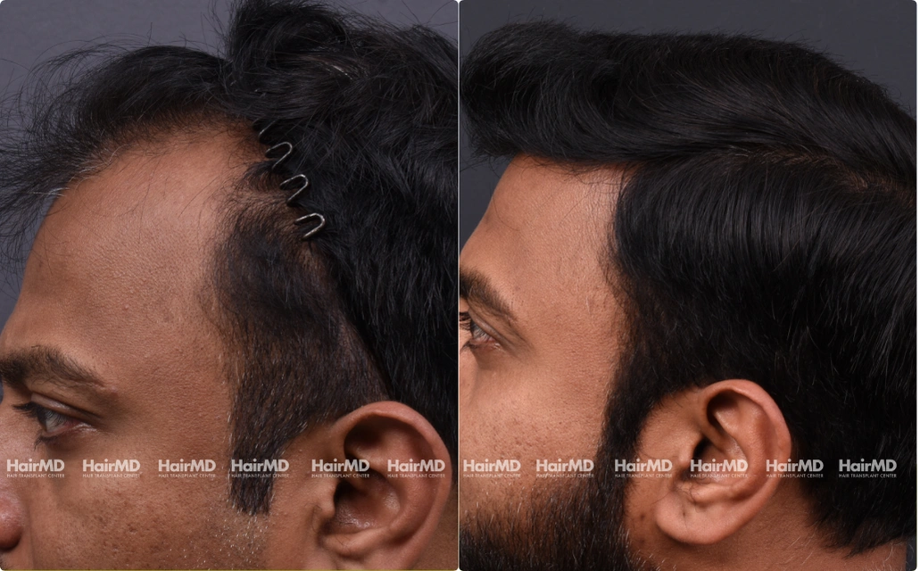 Hairtransplant Results 2 Years 2000-3000 Grafts HairMD Pune