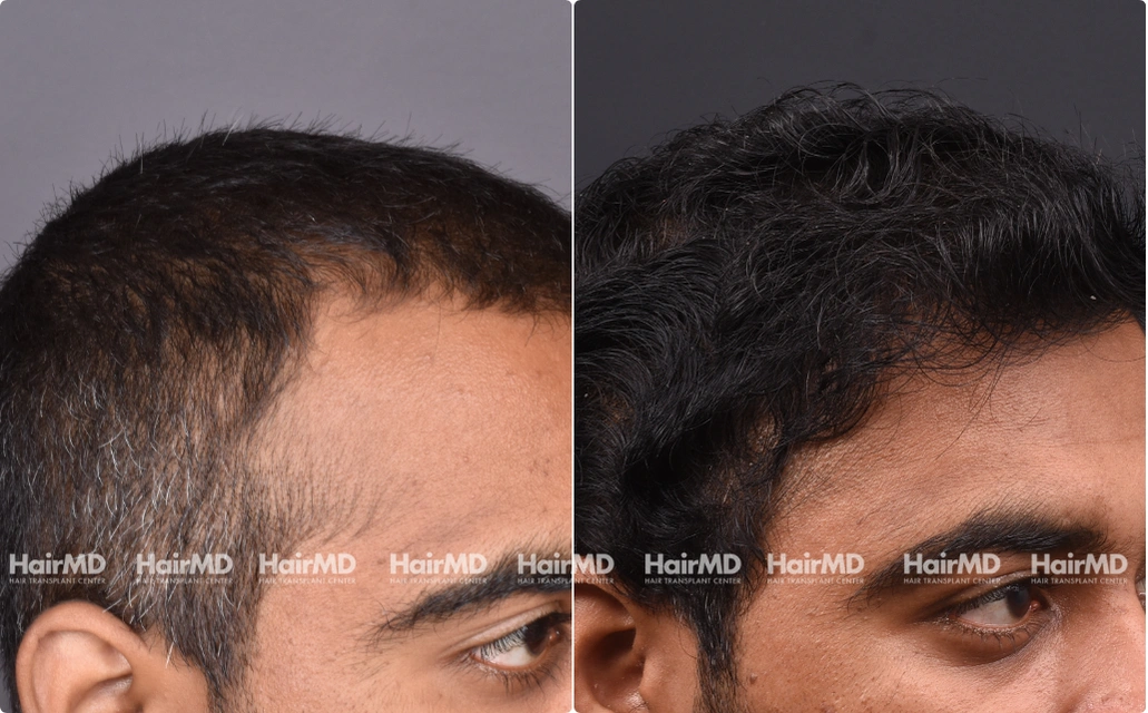 Hairtransplant Results 2 Years 2000-3000 Grafts HairMD Pune