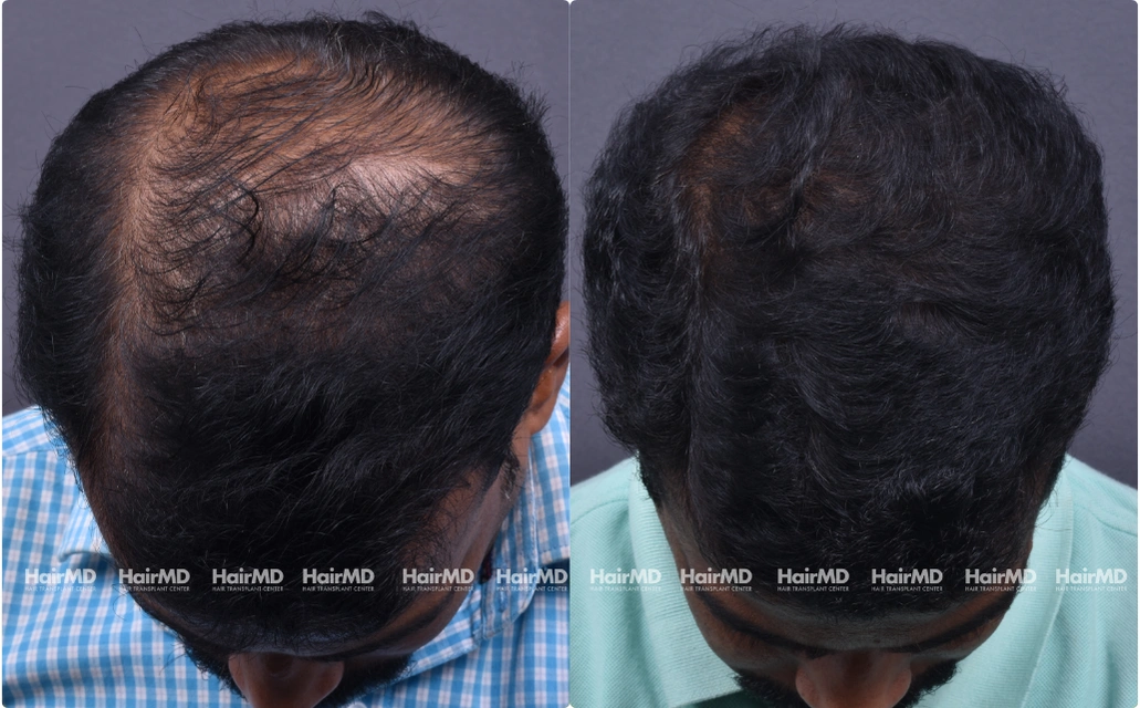 Hairtransplant Results 2 Years 2000 Grafts HairMD Pune