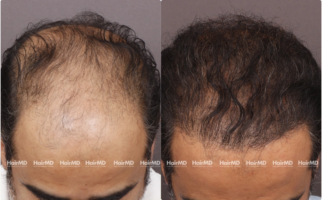 Hairtransplant Results 2 Years 4000-5000 Grafts HairMD Pune