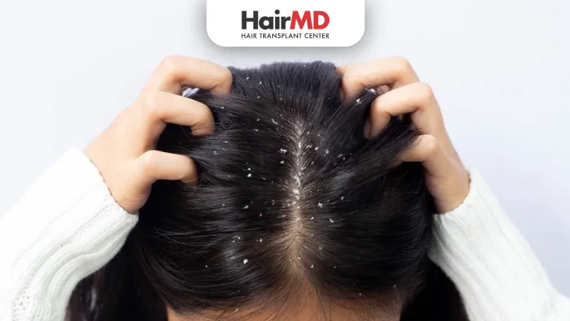 How-to-get-rid-of-dry-scalp-flakes-due-to-minoxidil-HairMD-Pune