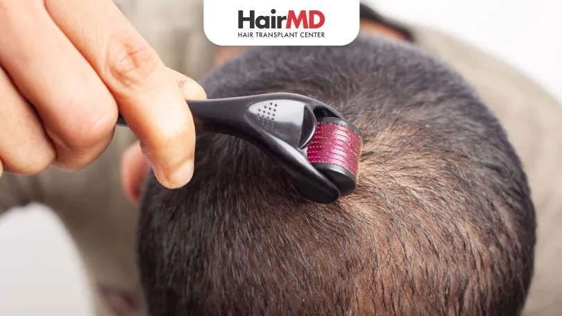 How-to-use-dermaroller-and-minoxidil-for-hair-loss-HairMD-Pune