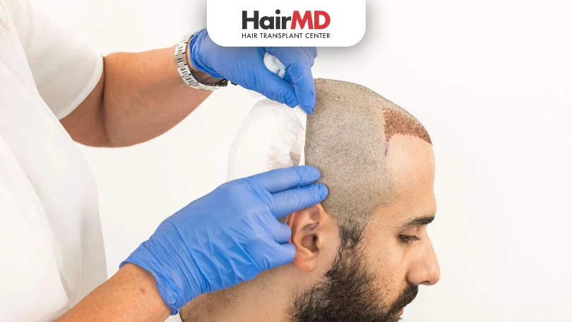 Is Hair Transplant Right for You? | Guide for Patients