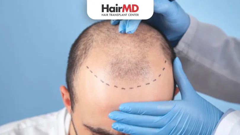 Is-Hair-transplant-a-right-choice-for-me-HairMD-Pune