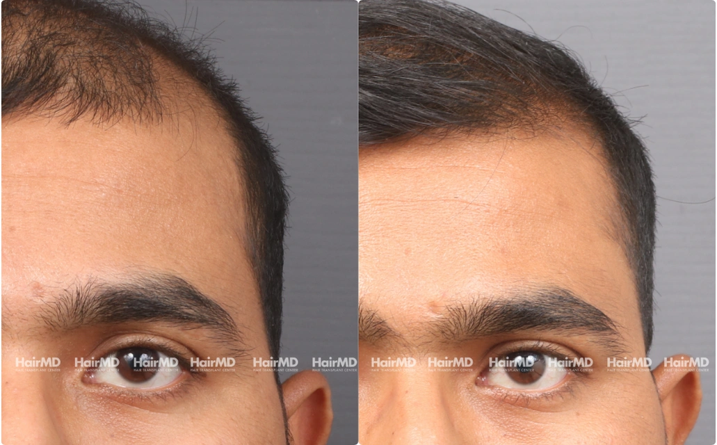 Male Hairloss Results 7 Sessions 6 Months HairMD Pune