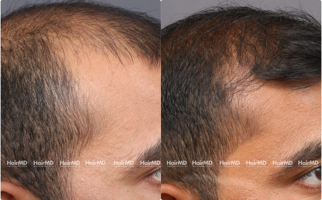 Male Hairloss Results 7 Sessions 6 Months HairMD Pune