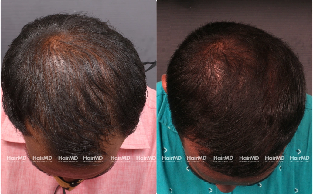 Male Hairloss Results 7 Sessions 6 Months HairMD Pune