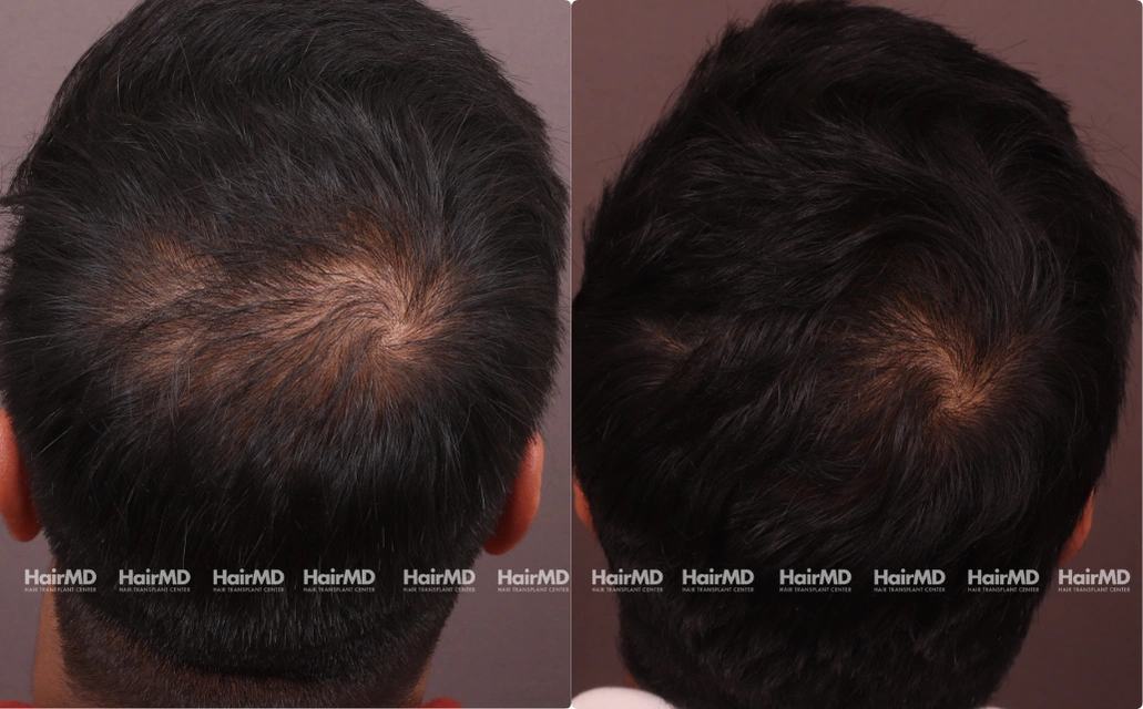 Male Hairloss Results 7 Sessions 6 Months ClearSkin Pune