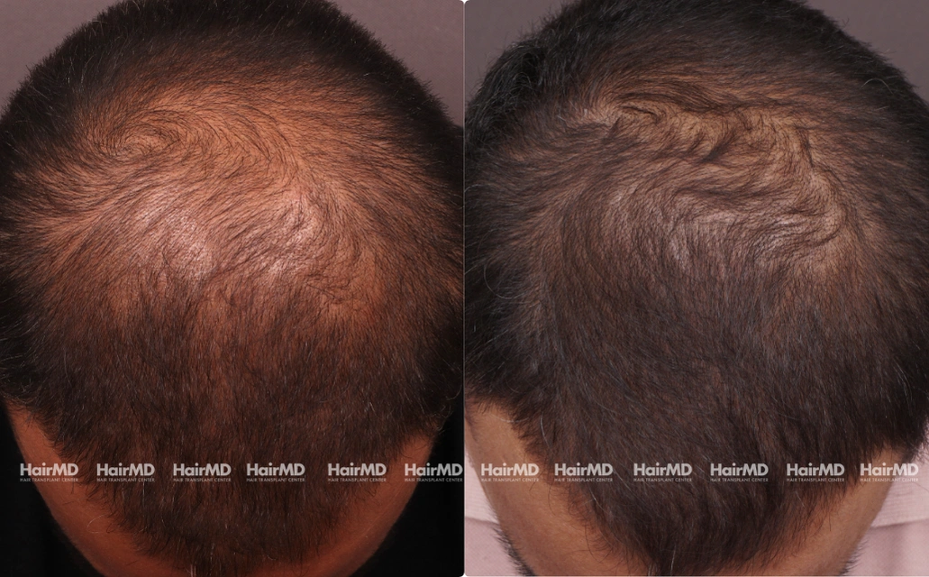 Male Hairloss Results 7 Sessions 6 Months HairMD Pune