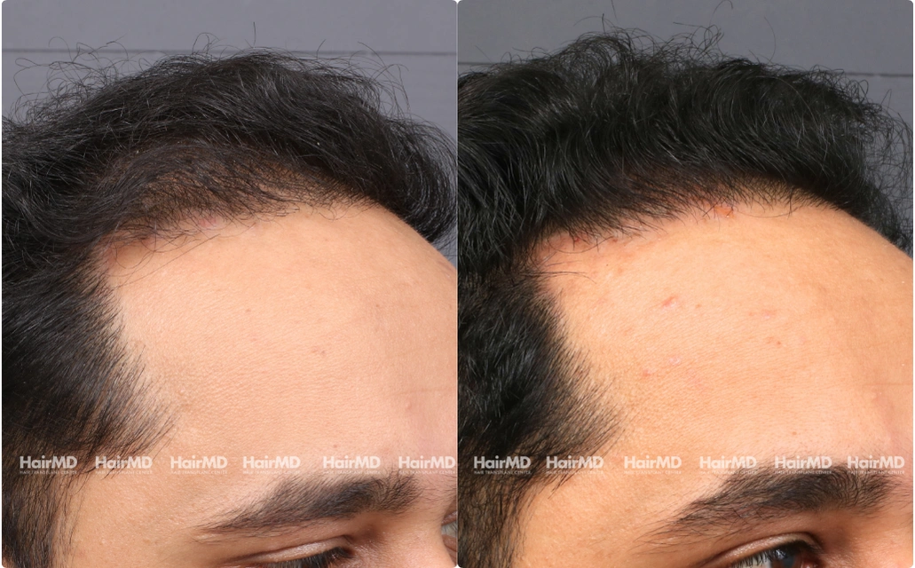 Male Hairloss Results 7 Sessions 6 Months HairMD Pune