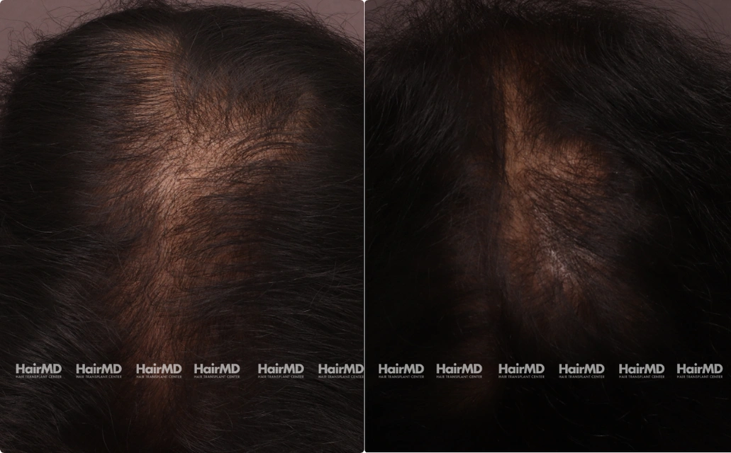 Male Hairloss Results 7 Sessions 6 Months HairMD Pune