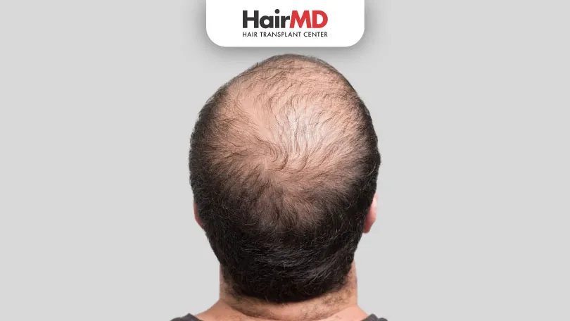 Male Pattern Baldness: All You Need To Know