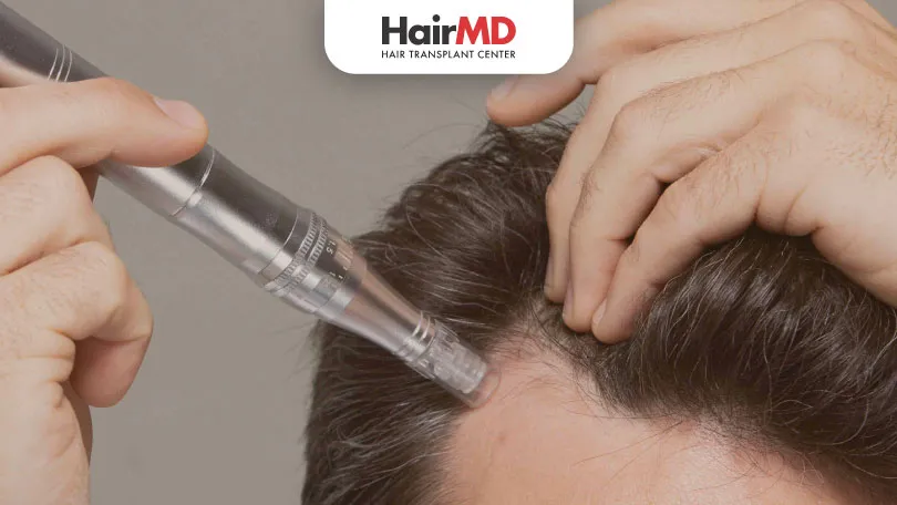 Microneedling for Hair Growth: A Promising Solution