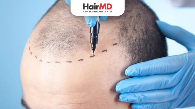 Most Effective Hair Transplant Method