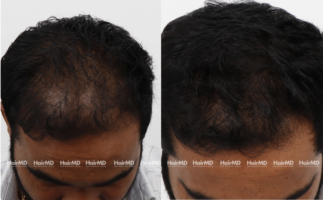 Nutritional Hair Loss Results 7 Sessions 6 Months HairMD Pune 2