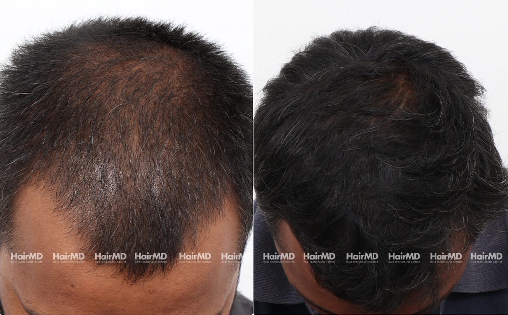 Nutritional Hair Loss Results 7 Sessions 6 Months HairMD Pune 3