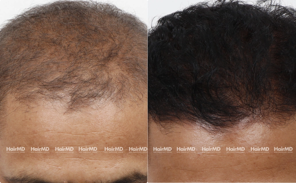 Nutritional Hair Loss Results 7 Sessions 6 Months HairMD Pune 4