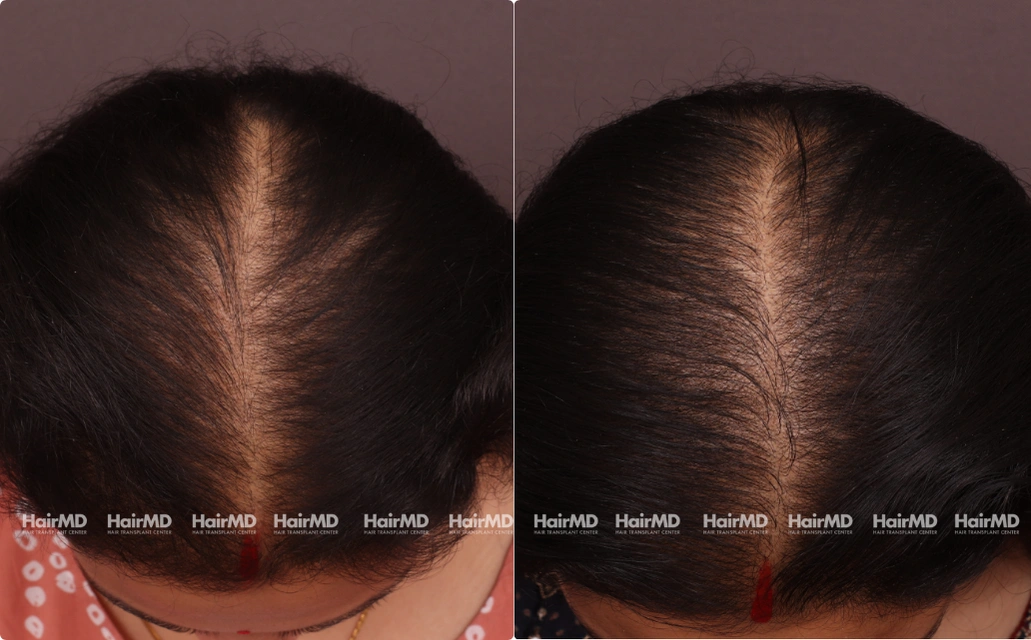 Nutritional Hair Loss Results 7 Sessions 6 Months HairMD Pune 5